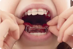 歯を抜かずに歯並びを治す