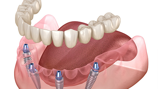 オールオンフォーインプラント