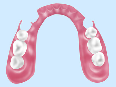 審美義歯（ノンクラスプデンチャー）