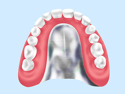 金属床義歯