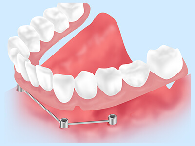 インプラントオーバーデンチャー