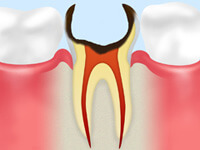 C4【歯根まで達した虫歯】