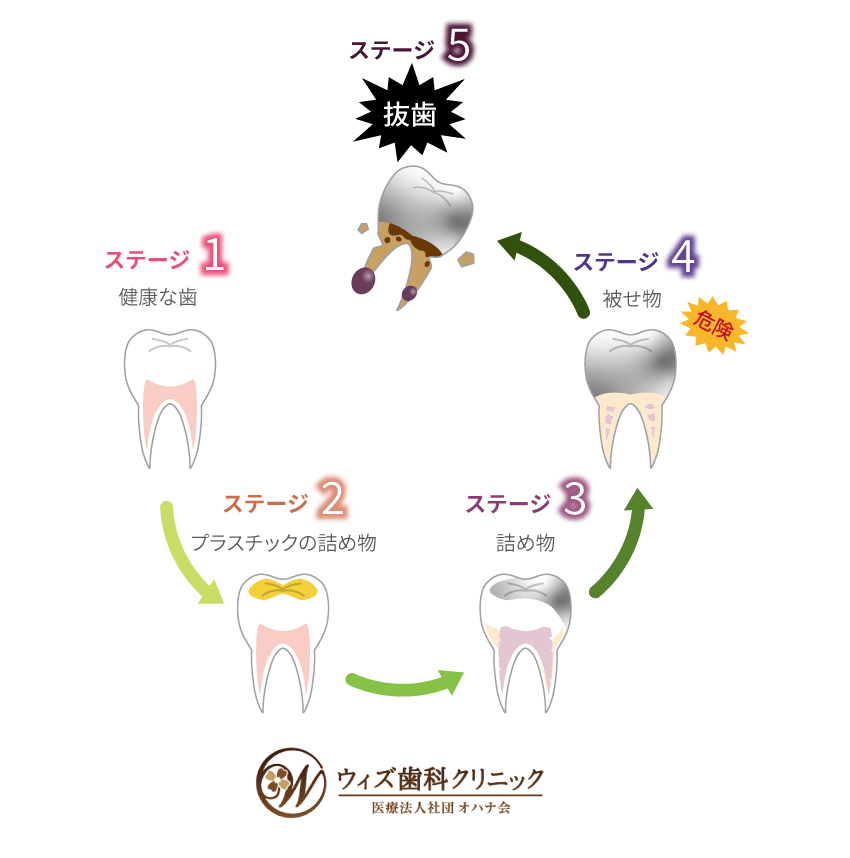 歯の一生サイクル