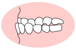 かがくぜんとつ 下顎前突