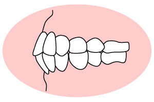 じょうげがくぜんとつ 上下顎前突