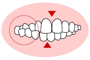 こうさこうごう 交叉咬合