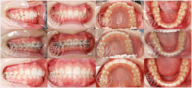 CASE1 非抜歯矯正