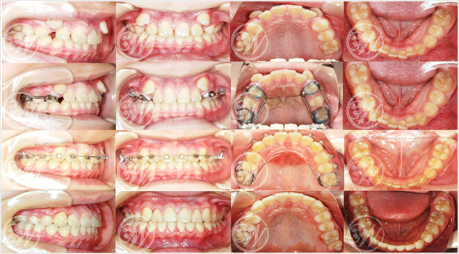 CASE2 ＧＭＤ＋非抜歯矯正