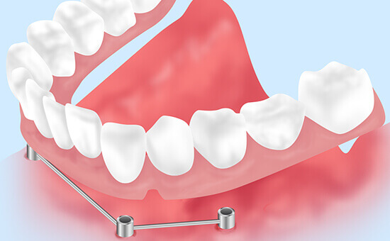 インプラントオーバーデンチャーについて