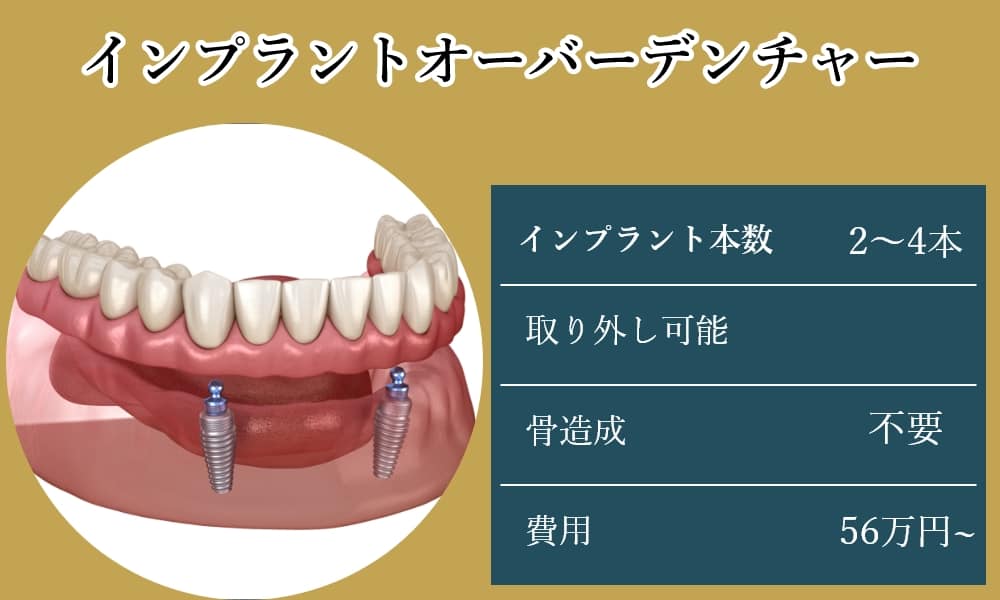 インプラントオーバーデンチャー