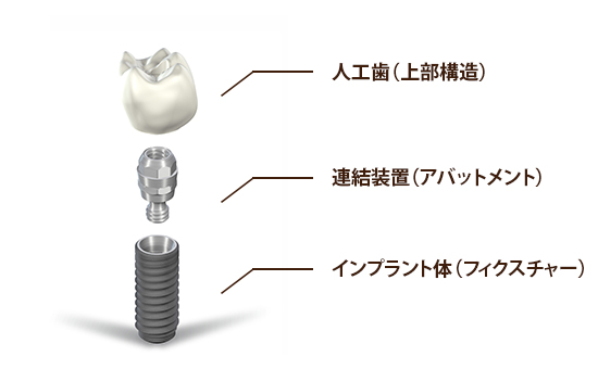 インプラントの構造