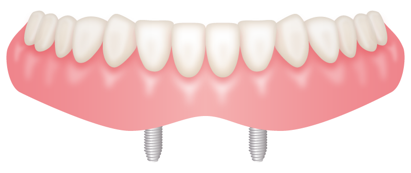 少ないインプラント本数で総義歯を安定させるインプラントオーバーデンチャー