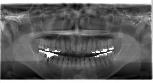 【症例】【右下6番の歯根破折部の抜歯後にインプラント治療を行った症例】