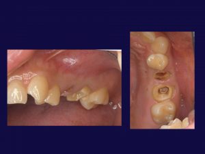 【症例】【歯肉の中にまで虫歯が進行してしまった歯の保存（クラウンレングスニング）】