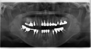 【症例】【右上5番を歯根破折のため抜歯しインプラント治療を行った症例】