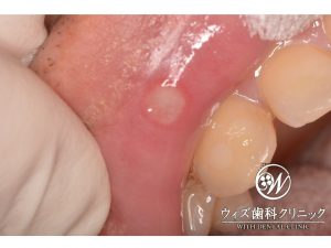 【症例】口内炎のレーザー治療
