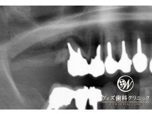 【症例】インプラント　骨造成