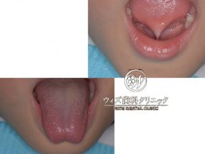 【症例】舌小帯短縮症