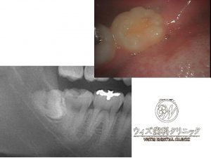 【症例】親知らずの抜歯（下顎）②