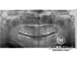 【症例】親知らず（下顎）の歯肉弁切除