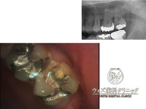 【症例】露髄歯の歯髄保存