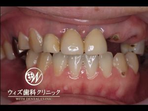 【症例】進行した虫歯治療