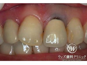 【症例】審美歯科・歯ぐきが黒ずんでいる　オールセラミックス
