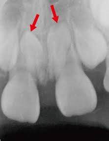 『豆知識』乳歯について⑦～過剰歯
