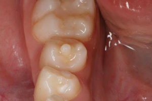 『豆知識』乳歯について⑧～中心結節