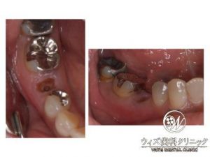 【症例】エクストルージョン、矯正的廷出