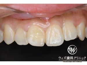 【症例】破折歯のオールセラミック修復