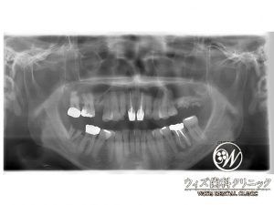 【症例】サイナスリフト（上顎洞挙上術）左上６,７