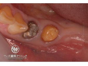 【症例】インプラント　左下６番　１次手術