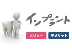 千葉でインプラントをお考えの方へ！メリットとデメリットを紹介　