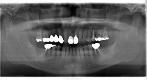 【症例】【下顎両側最後方臼歯のフラップレスインプラント症例】