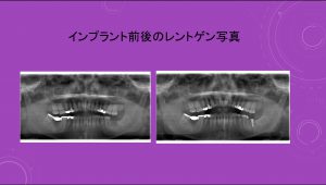 【左下の奥歯にインプラント治療をした症例】