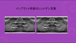 【症例】【左下の奥歯にインプラント治療をした症例】