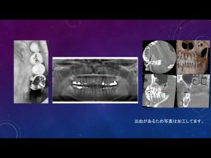【歯根破折により左上の奥歯の保存が不可能になった患者様でインプラントによる治療を希望された症例】