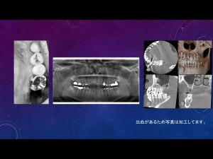 【症例】【歯根破折により左上の奥歯の保存が不可能になった患者様でインプラントによる治療を希望された症例】