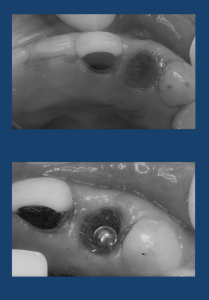 【症例】セカンドオピニオンで来院された患者様へ抜歯即時埋入即時荷重インプラント治療を行った症例