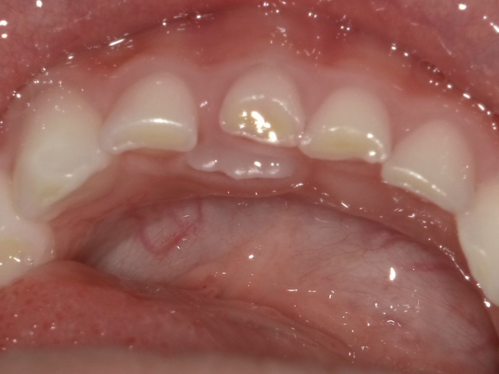 乳歯 と 永久歯 が 写っ て いる レントゲン 写真