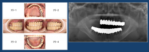 【症例】【静脈内鎮静下でのインプラントオーバーデンチャーのインプラント埋入オペ】