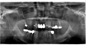 【症例】【入れ歯のリスクと精密なインプラント治療】