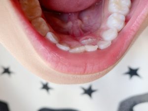 乳歯が抜けないまま永久歯が生えてきてしまった時の対応とは？
