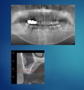 【症例】右上の上顎洞底挙上術、サイナスリフトにて骨の造成を行った症例