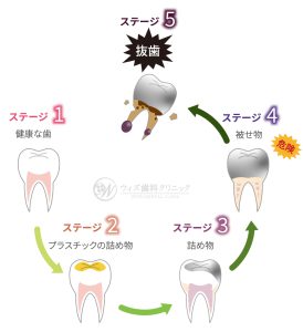 【症例】歯の神経を抜かずに保存した症例