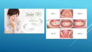 【症例】前歯部の隙っ歯をマウスピースを使って矯正を行いました。