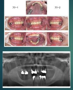 【症例】左側上顎洞にサイナスリフトという骨造成術を行い奥歯の噛み合わせを治療しました。