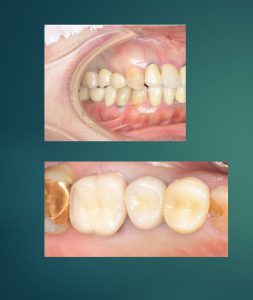 【症例】右上の奥歯を歯根破折で抜歯しインプラント治療を行なった患者様の上部構造