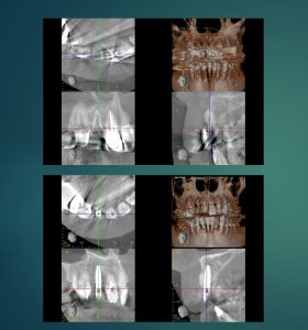 【症例】抜歯即時埋入と当院のインプラントシステムについて